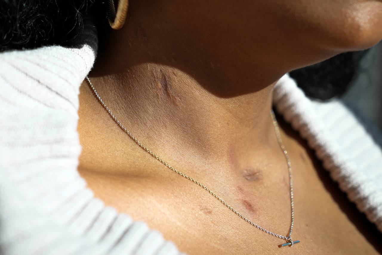 Simone Day displays some of her scars from a hospitalization after suffering respiratory failure in 2016 while sitting for a portrait in Federal Hill on December 22, 2023.