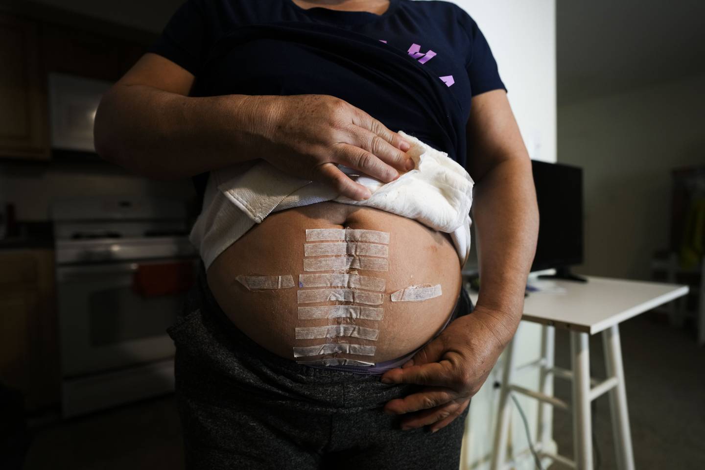Verónica del Cid Gaitán, an undocumented immigrant, shows her recent incisions from a surgery to remove a tumor in her colon. She has had one recent follow-up appointment with another scheduled in June and has no insurance to cover them. She is pictured here in her home on April 14, 2023.